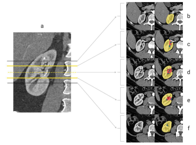 Computer Generated R.E.N.A.L. Nephrometry visualization